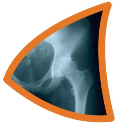 hip_xray